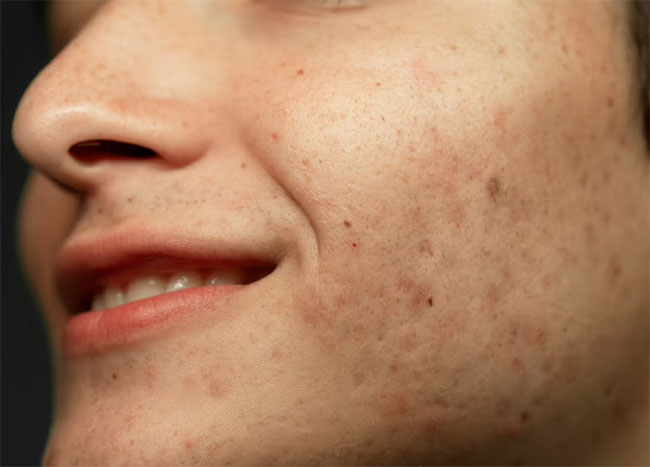 Acne Scar Solutions, Causes and How to Treat Them 