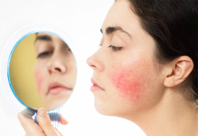 Basic Skincare Tips and Remedies for Acne and Rosacea 